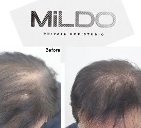 동래두피문신 : MiLDO_SMP